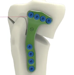 Activmotion S – Medial Opening Wedge HTO Plate (Size 2)