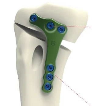 Activmotion S – HTO Plate with ACL Reconstruction