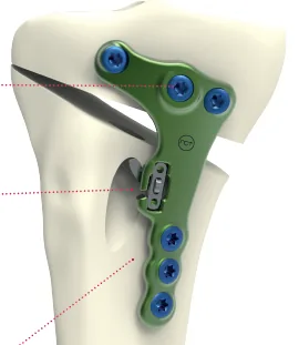 Activmotion S – HTO Plate with ACL Reconstruction & Suture Button