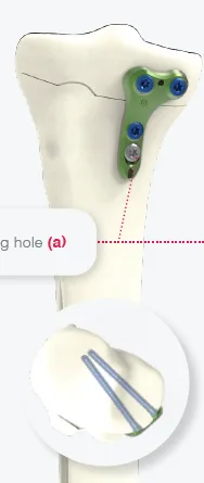 Medial Closing Wedge HTO Plate (Size 1)