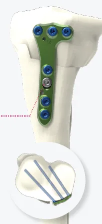 Medial Closing Wedge HTO Plate (Size 2)