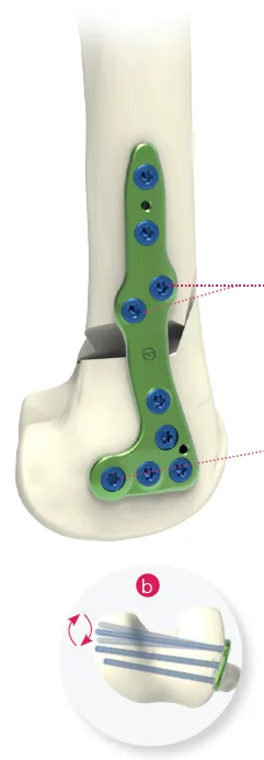 Lateral Opening Distal Femoral Osteotomy (DFO) Plate