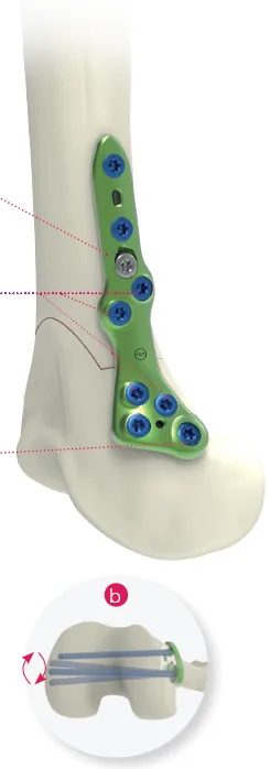 Medial Closing Distal Femoral Osteotomy (DFO) Plate
