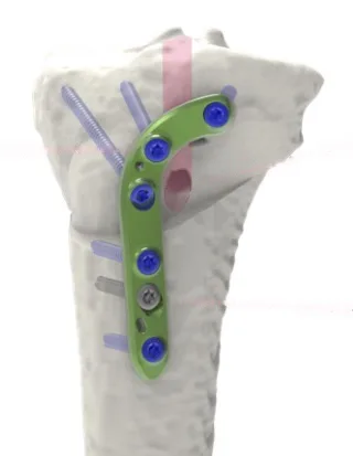 Deflexion Osteotomy Plate – Size 2