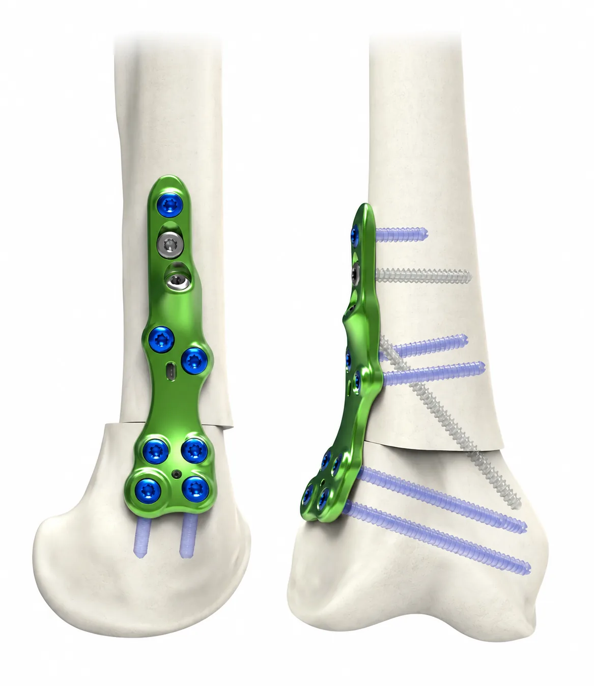 Knee Osteotomy Portfolio