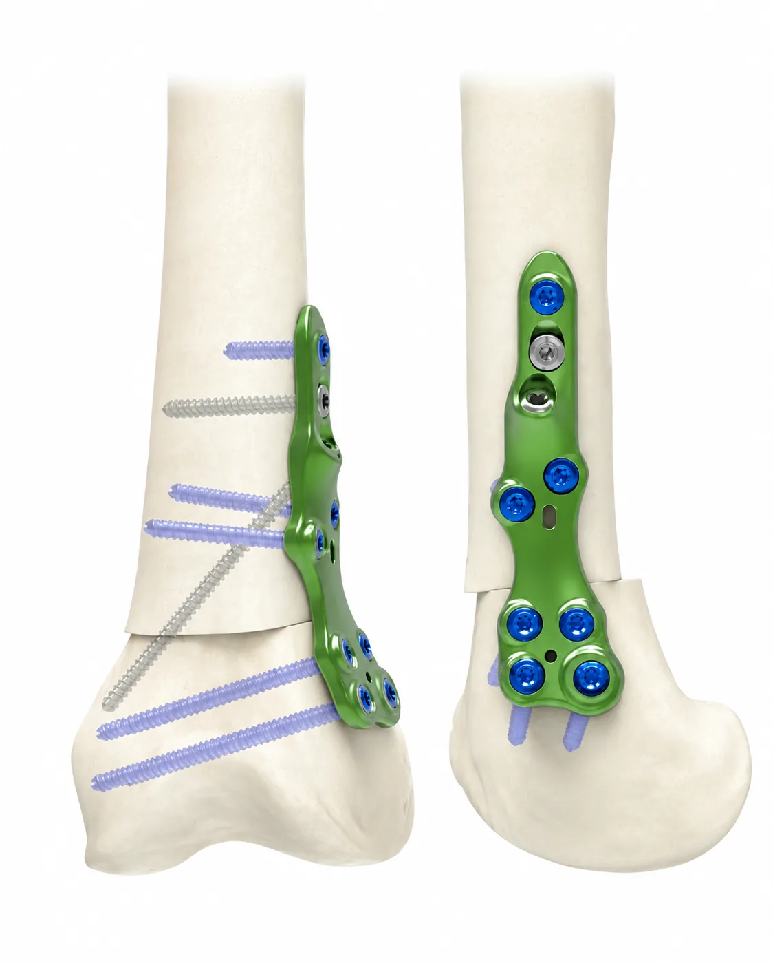 Distal Femoral Derotation Plate – Medial