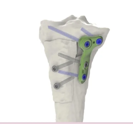 Deflexion Osteotomy Plate – Size 1